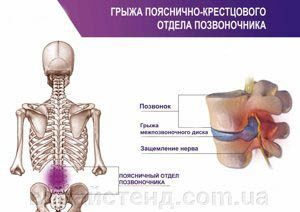 грыжа пояснично-крестцового отдела позвоночника