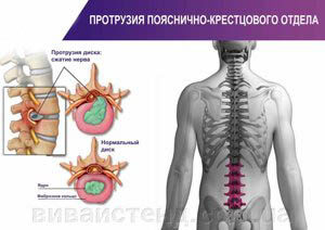 протрузия пояснично-крестцового отдела